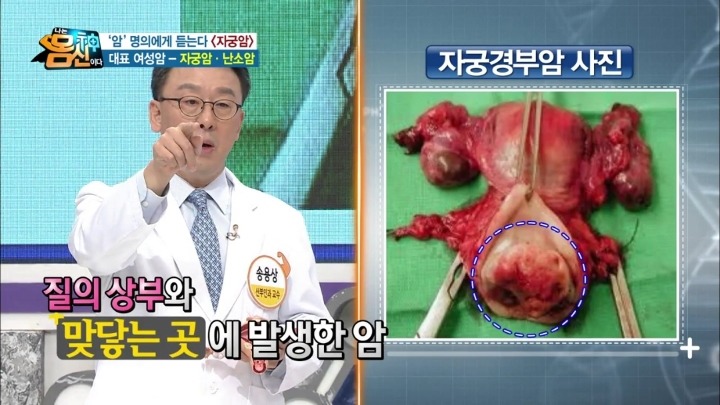 자궁경부암 실제사진.jpg (사진주의) | 인스티즈