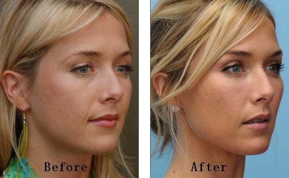 미국에서 은근히 많이하는 성형수술 세가지 | 인스티즈