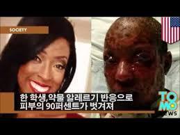 모든약으로 걸릴수있는 스티븐존슨 증후군 (난감) | 인스티즈