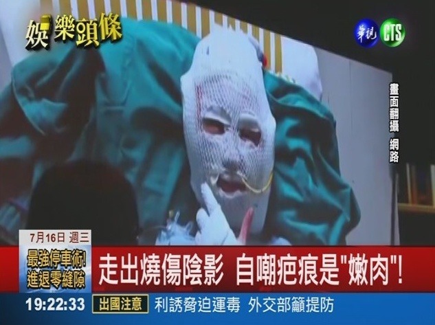 전신 3도 화상을 입은 중국 아이돌 | 인스티즈