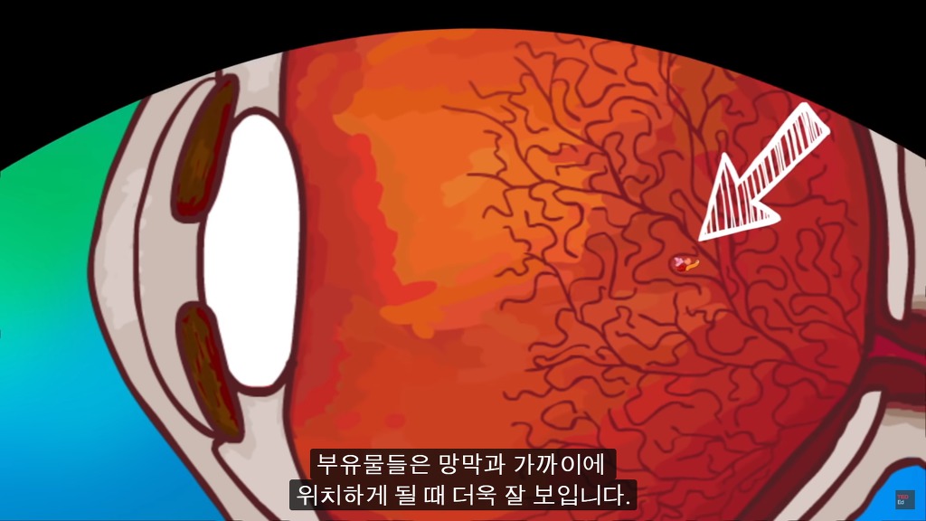 여러분의 눈에 둥둥 떠다니는 그것들은 무엇일까요? | 인스티즈