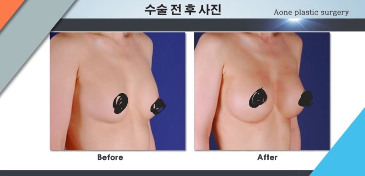 보형물 이용한 가슴성형.jpg (사진주의) | 인스티즈